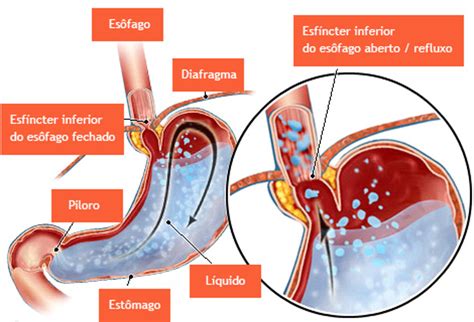 Doença do Refluxo Gastroesofágico GastroVida