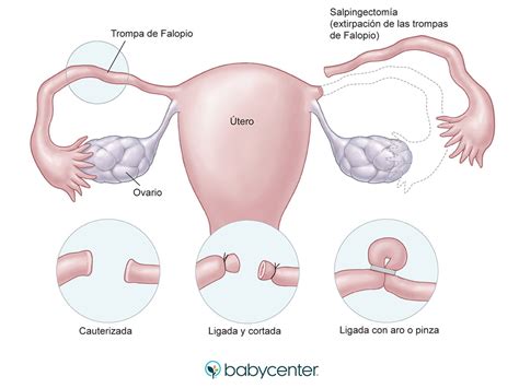 La Esterilizaci N Femenina Babycenter