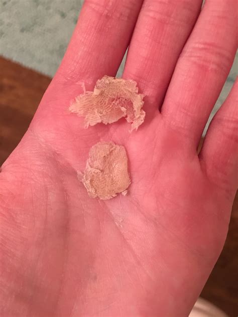 calluses off the balls of my feet, removed with #10 surgical blade : r