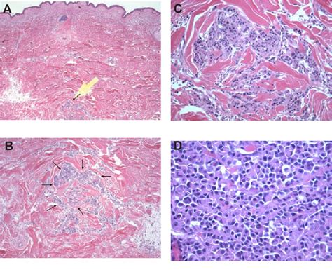 Figure 1 From Amelanotic Melanoma Presenting With Plasmacytoid