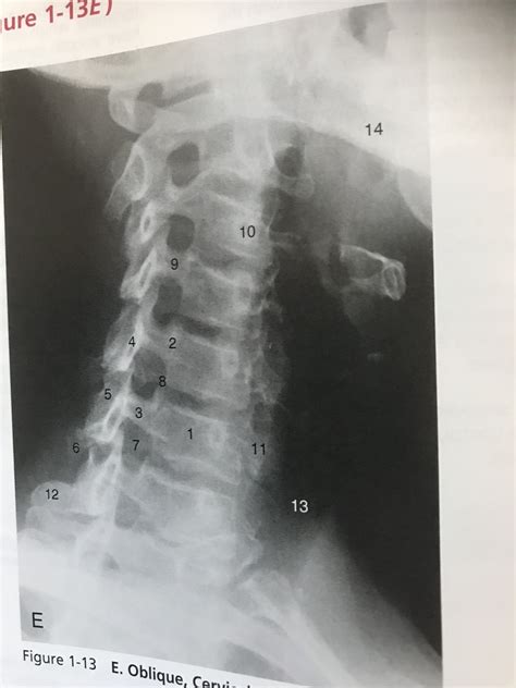 Textbook Cervical Oblique Diagram Quizlet