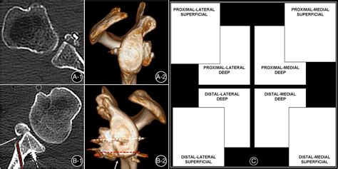 Early Followup Of Arthroscopic Latarjet Procedure With Screw Or Suture