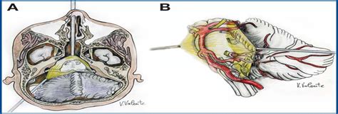 Endoscopic Endonasal Transclival Approach And Retrosigmoid A