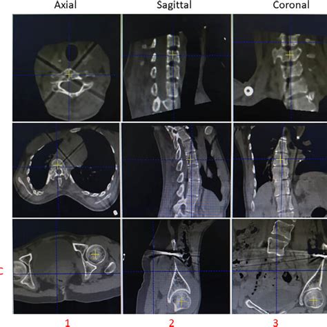 Quantitative Computed Tomography Bone Mineral Density Analysis System