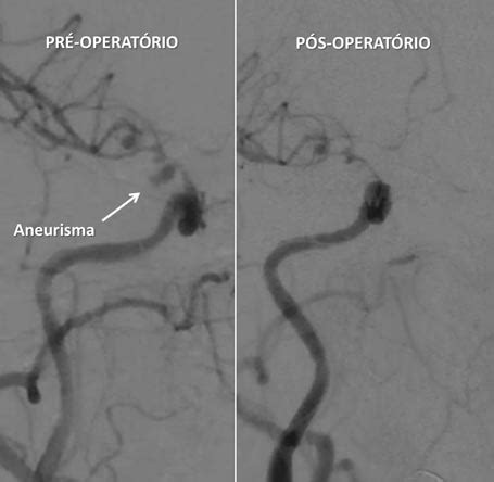 Hgv Realiza Cirurgia P Blica De Emboliza O De Aneurisma Cerebral