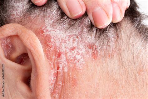 Detail Of Psoriatic Skin Disease Psoriasis Vulgaris In Hair And Ear