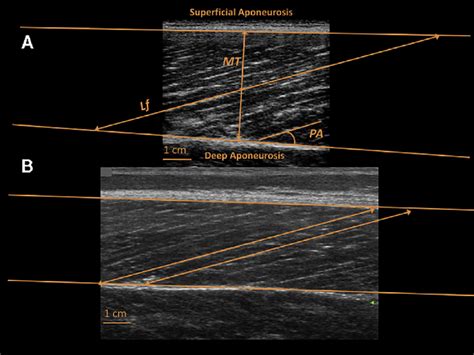 Longitudinal B Mode Ultrasound Scans Of The Vastus Lateralis Acquired