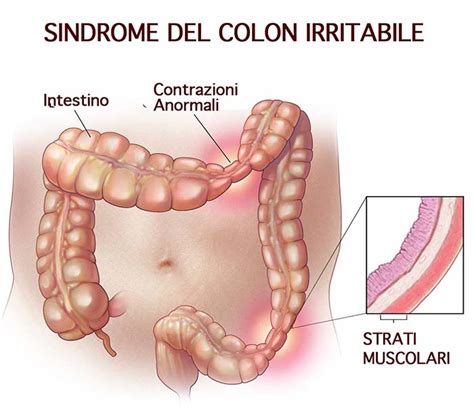 La Sindrome Del Colon Irritabile E LAlimentazione Crudista