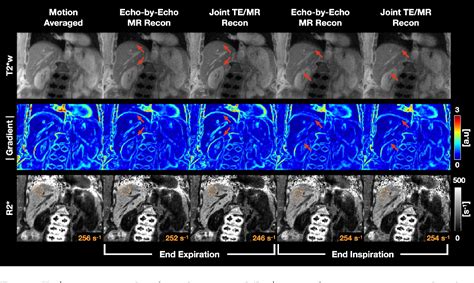 Figure From Joint Multi Echo Respiratory Motion Resolved Compressed