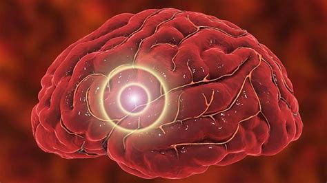 Aneurisma Que Es Sintomas Causas Y Tratamiento Aneurisma Cerebral