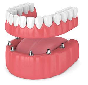 Great Smile Denture Clinic | Implant Retained Dentures