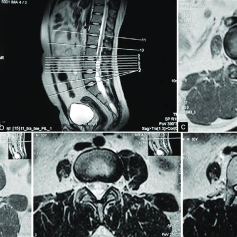 A Sagittal T1 Weighted Magnetic Resonance Imaging Scan Revealing A