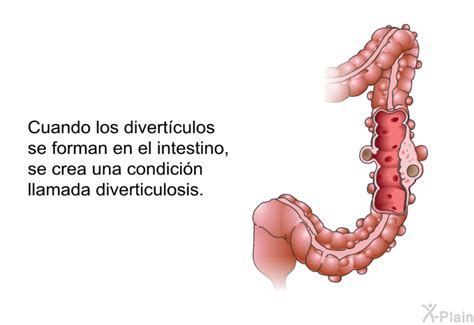 PatEdu Diverticulosis y tratamiento quirúrgico para la diverticulitis