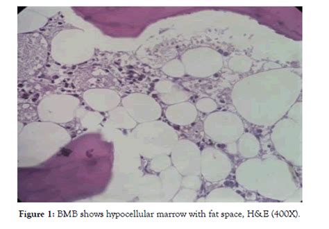 Bone Marrow Biopsy Evaluation In Cases Of Pancytopenia An Institutional