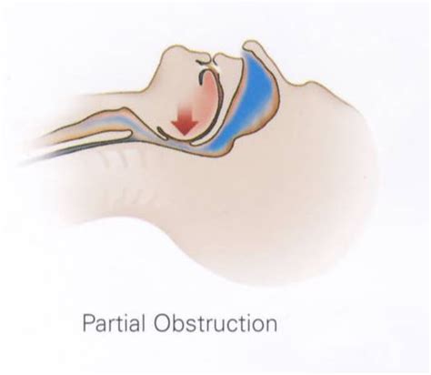 Sleep And Neurology Obstructive Sleep Apnea 101 The Main Facts