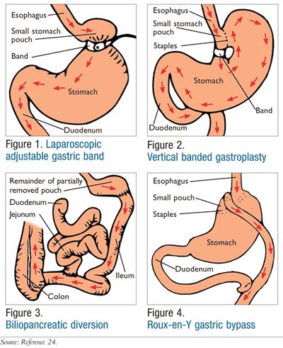 Bariatric Surgery And Type 2 Diabetes - DiabetesWalls