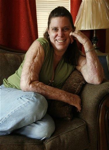 Linda Fisher Who Was Severely Burned In The Station Nightclub Fire