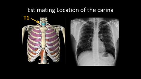 Basic Chest Radiology Et Tube Position And Complications Youtube