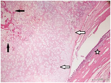 Solitary Synovial Chondromatosis Arising In The Gluteus Maximus Bursa