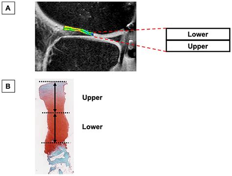 Histological Analysis Of Cartilage Defects Repaired With An Autologous