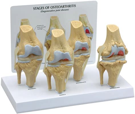stage osteoarthritis knee model gpi