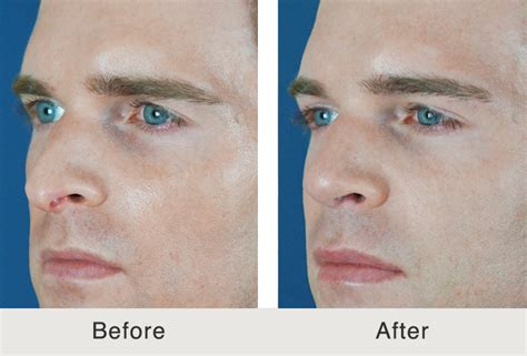 Before After Male Filler Temples And Tear Trough Carolina Facial