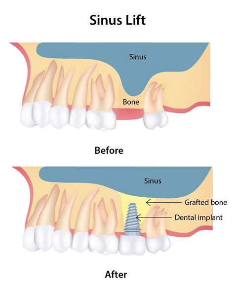 What Is Sinus Lifting Alfa