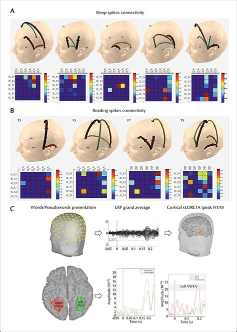 JLE Epileptic Disorders Visual Word Form Area Hyperexcitability