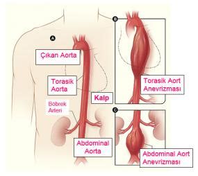 Aort Anevrizması Aort Genişlemesi Selim Isbir MD Professor