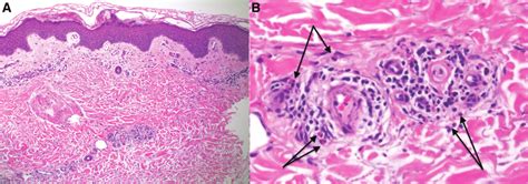 Histopathology Of Lesional Skin Biopsy A Low Power Histopathology