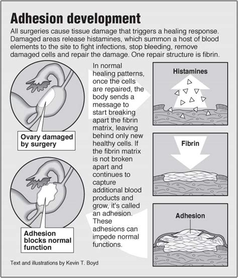 Adhesion Development Pointfinder Health Infographics