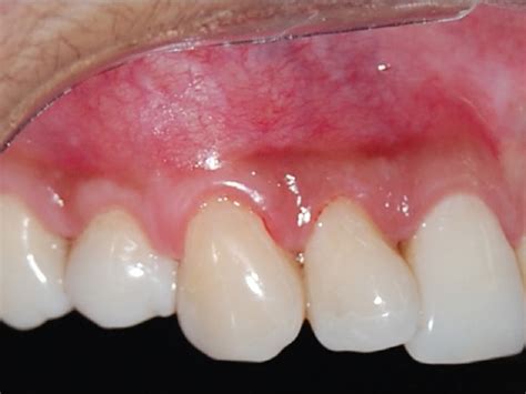 Pinhole Gum Surgery What To Know Web Dmd