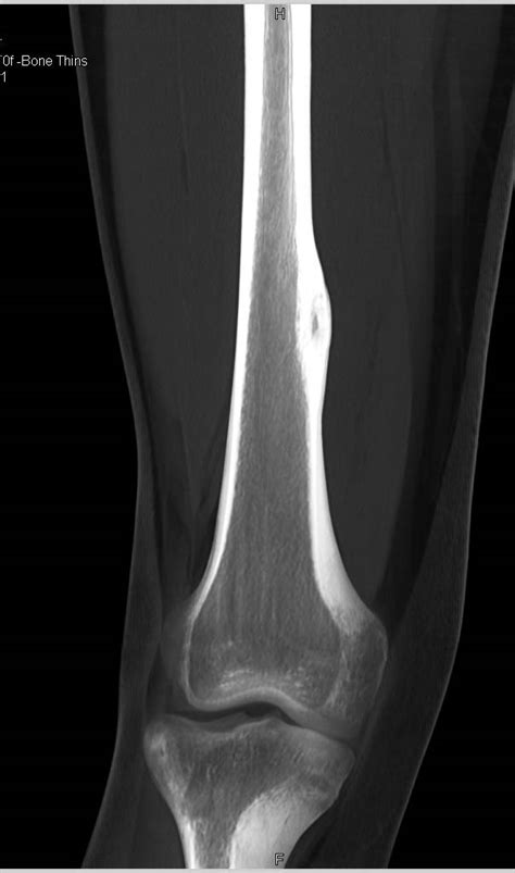 Osteoid Osteoma Femur