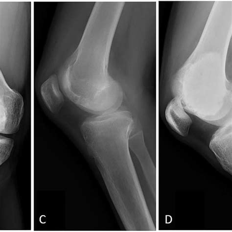 A C Case No 6 Male 15 Years Of Age With GCTB At The Distal Femur