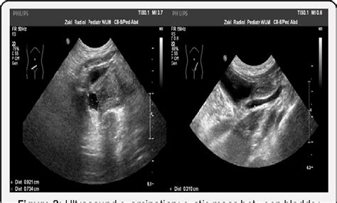 Gartners Duct Cyst Ultrasound