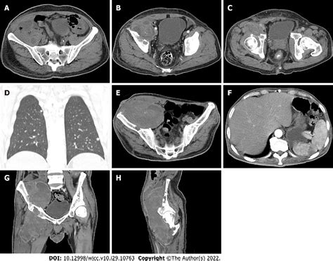 Figure 6 From Malignant Giant Cell Tumors Of The Tendon Sheath Of The Right Hip A Case Report