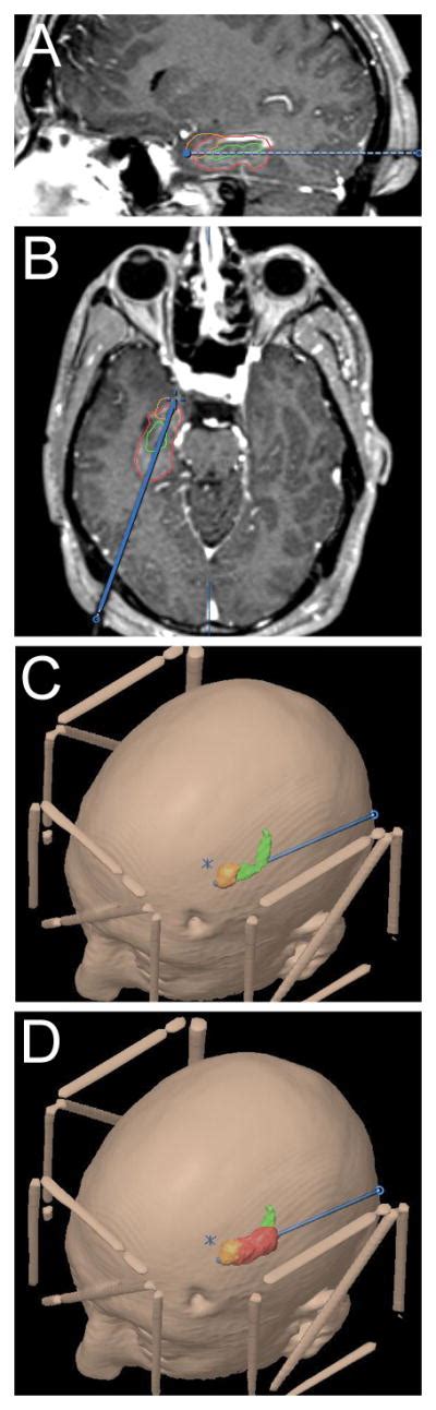 Real Time Magnetic Resonance Guided Stereotactic Laser Amygdalohippocampotomy For Mesial