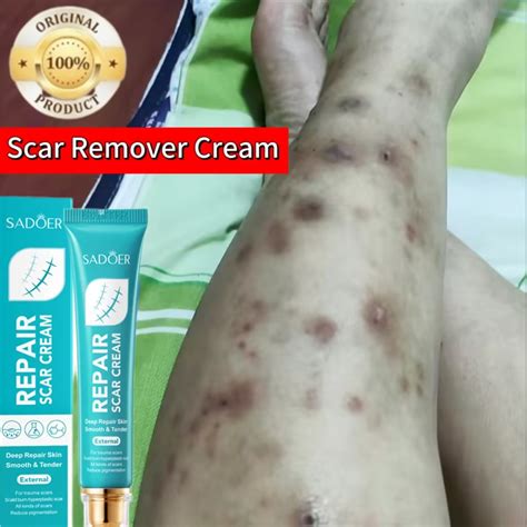 Scar Remover Cream Scar Peklat Remover Cream For Old Peklat Scar