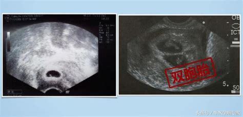 准爸媽要了解的孕期知識之孕早期b超 每日頭條