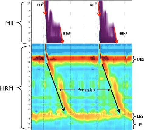 Example Of Two Normal Swallows At High Resolution Impedance Manometry