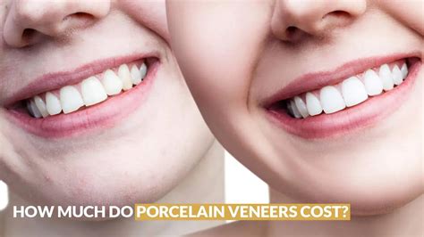 How Much Do Porcelain Veneers Cost What To Expect