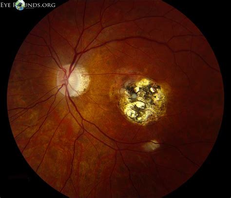 Ocular Toxoplasmosis