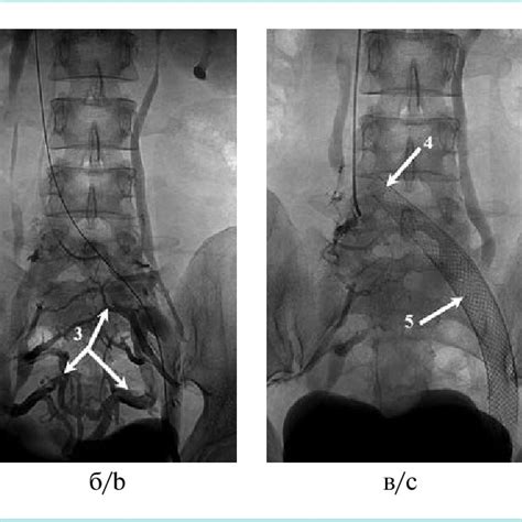 Pelvic Phlebography Patient E 32 Years Old A Compression Stenosis