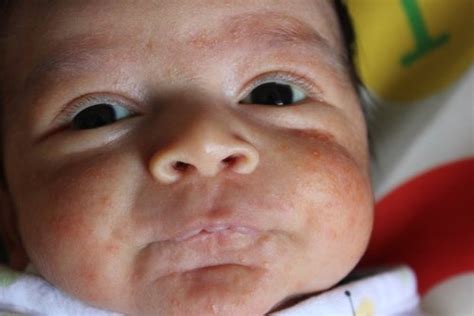 Seborrheic Dermatitis | BabyCenter