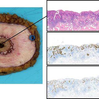 Histopathological Examination Showing The Gross Specimen And