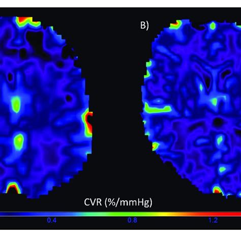 Representative Voxelwise Cerebrovascular Reactivity Cvr Magnitude