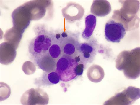 Malaria Associated Secondary Hemophagocytic Lymphohistiocytosis A Case