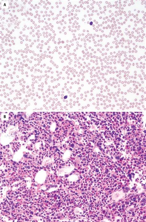 Myelodysplastic Syndromes Clinical Tree