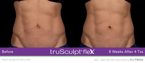 Trusculpt® Flex Fayetteville Nc Raleigh Trusculpt® Flex