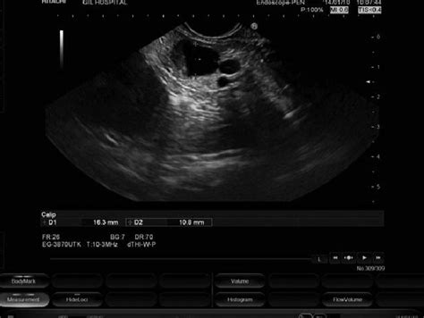 A 1.6 cm anechoic cystic lesion with peripheral hyperechoic spots ...